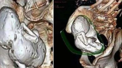 VIRAL HINDI NEWS: महिला के पेट में 35 साल से पल रहा था भ्रूण
