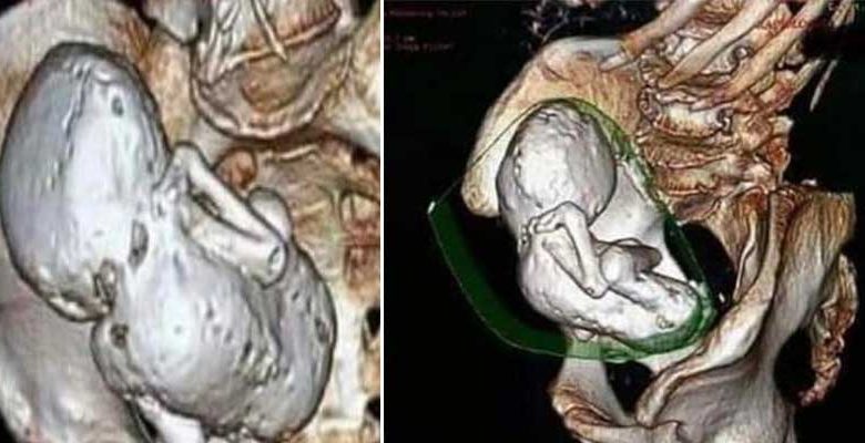 VIRAL HINDI NEWS: महिला के पेट में 35 साल से पल रहा था भ्रूण